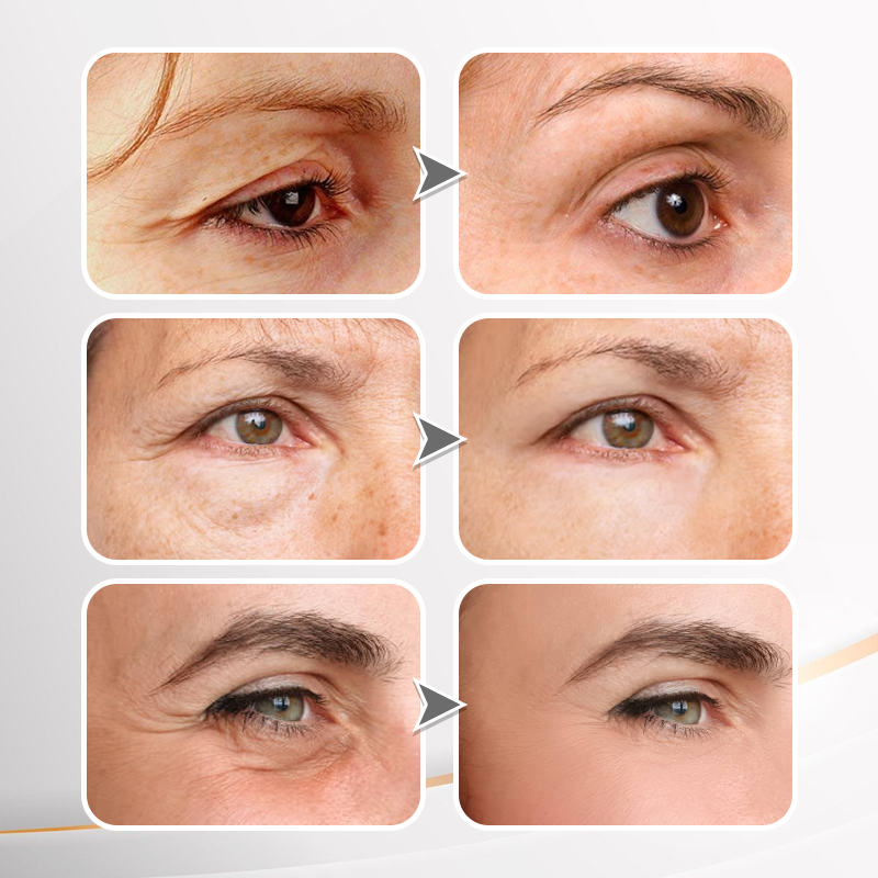 Jorondy® Instant Wrinkle Eye Tightener cream 🔥 Last Day Discount: 80% OFF 🔥